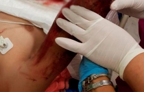 Toluca: chavo pierde la mano en volcadura