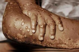 El primer caso de viruela símica en humanos se registró en 1970.