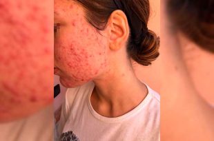 Dermatólogos advierten que la automedicación puede agravar la enfermedad y retrasar su control